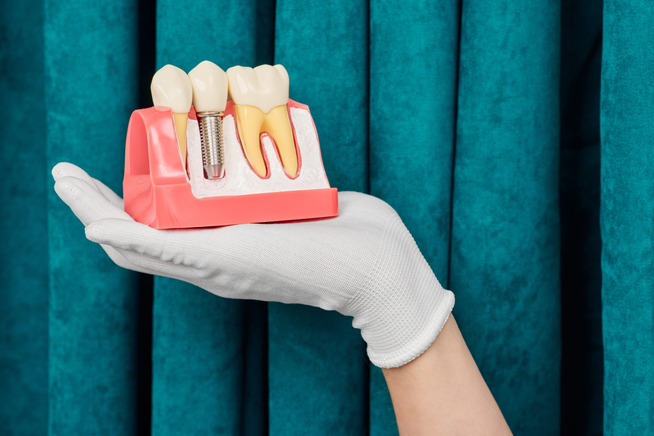 Dental Implant
