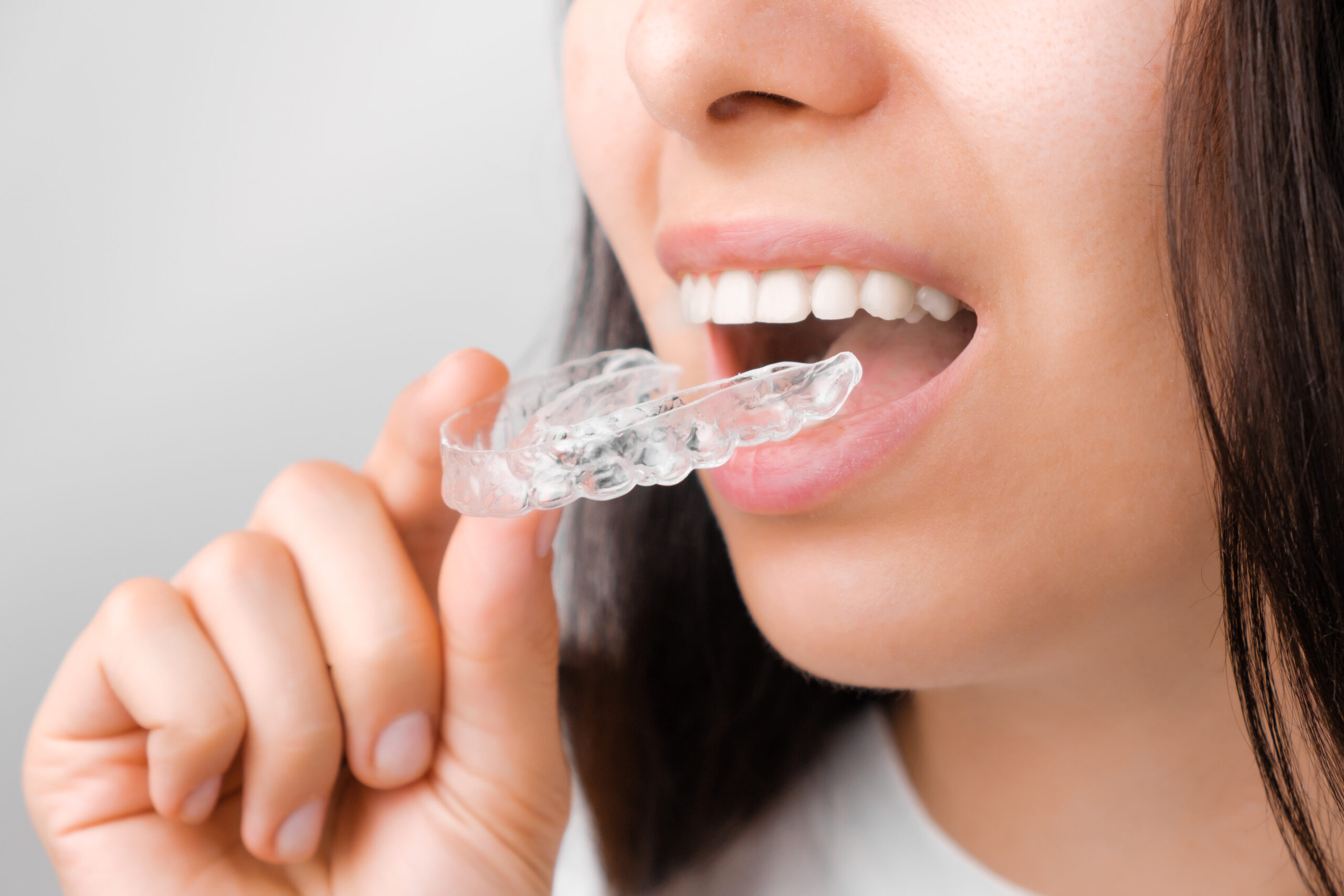 Aligners